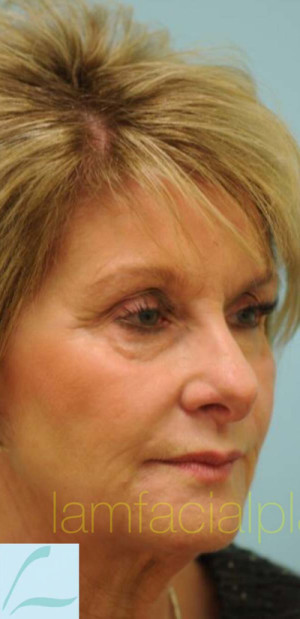 Revision/Corrective Rhinoplasty
