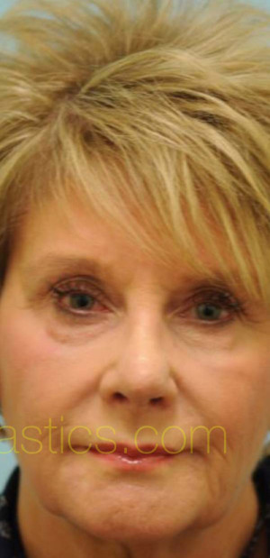 Revision/Corrective Rhinoplasty