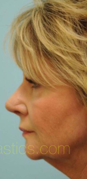 Revision/Corrective Rhinoplasty