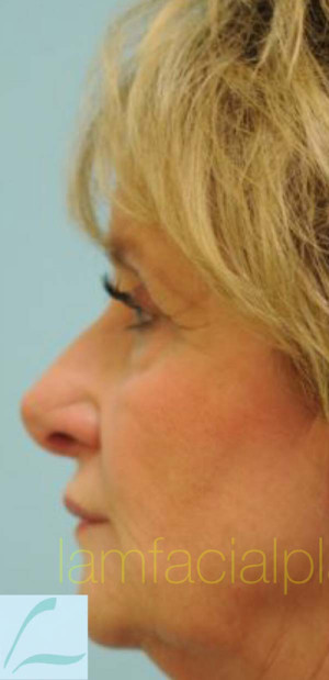 Revision/Corrective Rhinoplasty