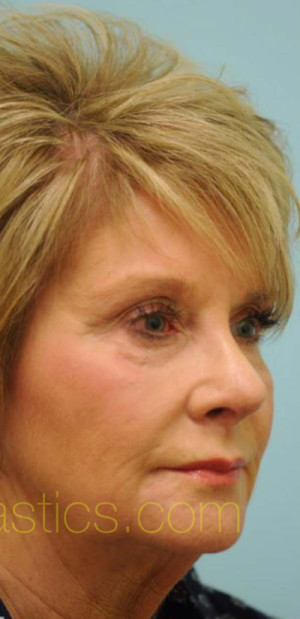Revision/Corrective Rhinoplasty