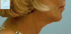 Lower Face & Neck Rejuvenation