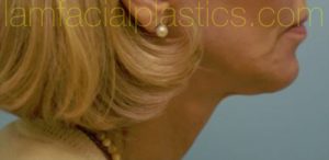 Lower Face & Neck Rejuvenation