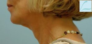 Lower Face & Neck Rejuvenation