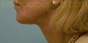 Lower Face & Neck Rejuvenation