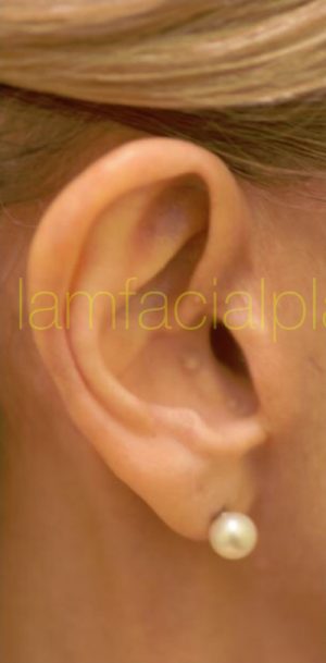 Lower Face & Neck Rejuvenation