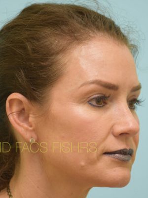 Eyelid Rejuvenation