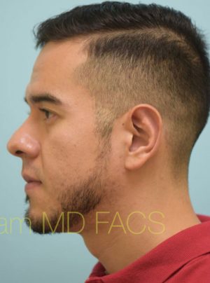 Otoplasty (Cosmetic Ear Reshaping)