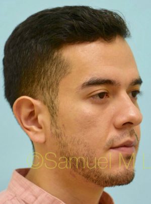 Otoplasty (Cosmetic Ear Reshaping)