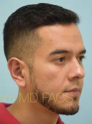 Otoplasty (Cosmetic Ear Reshaping)