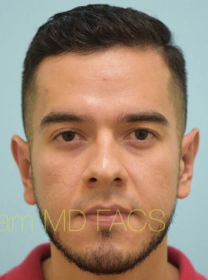 Otoplasty (Cosmetic Ear Reshaping)