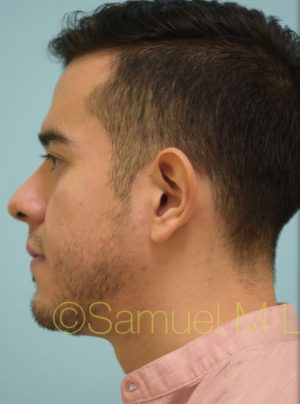 Otoplasty (Cosmetic Ear Reshaping)