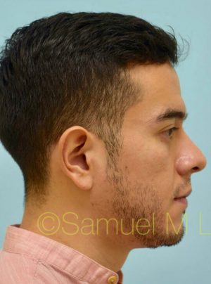 Otoplasty (Cosmetic Ear Reshaping)