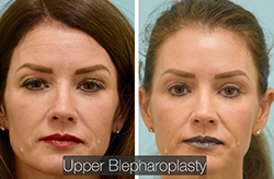Upper Blepharoplasty Result Plano