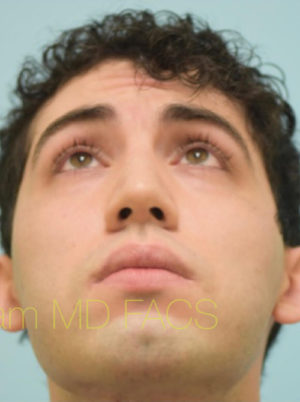 Rhinoplasty-Nose Job