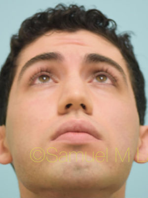Rhinoplasty-Nose Job