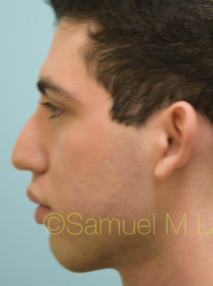 Rhinoplasty-Nose Job