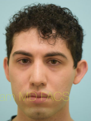 Rhinoplasty-Nose Job