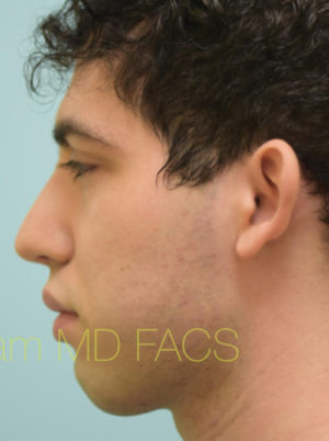 Rhinoplasty-Nose Job