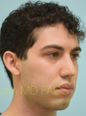 Rhinoplasty-Nose Job