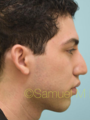 Rhinoplasty-Nose Job