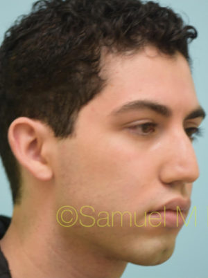 Rhinoplasty-Nose Job
