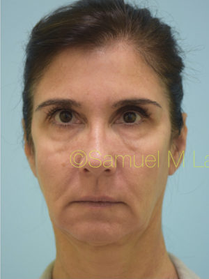 Chin Augmentation