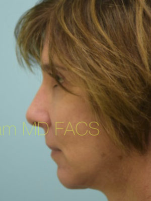 Chin Augmentation