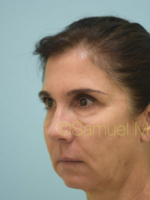 Chin Augmentation