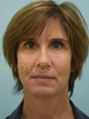 Chin Augmentation