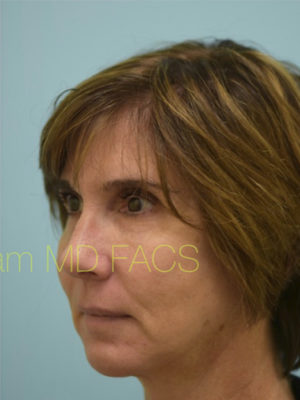 Chin Augmentation