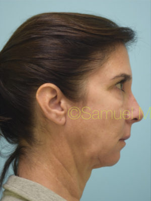 Chin Augmentation