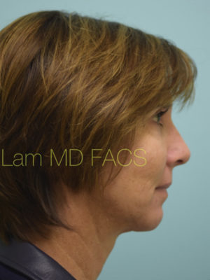 Chin Augmentation