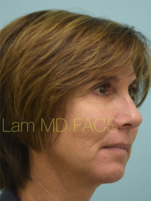 Chin Augmentation