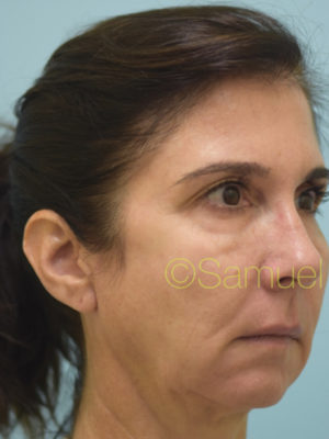 Chin Augmentation