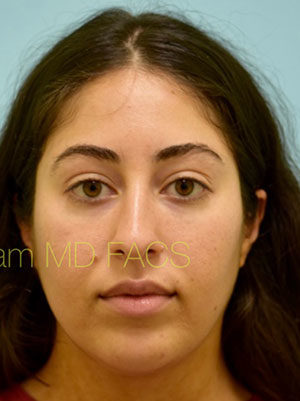 Botox