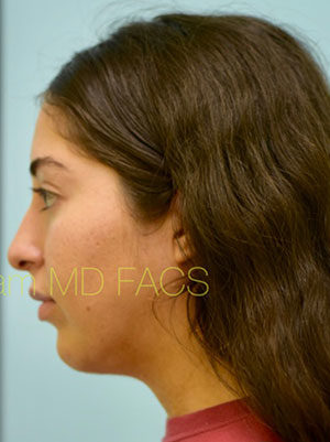 Botox