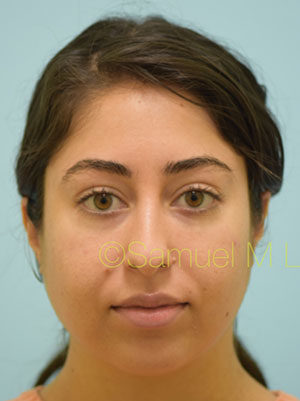 Botox
