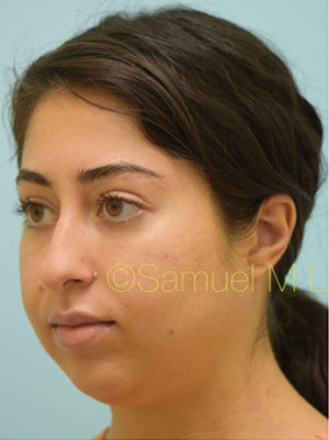 Botox