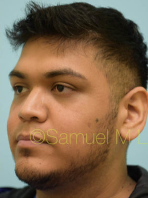 Rhinoplasty-Nose Job