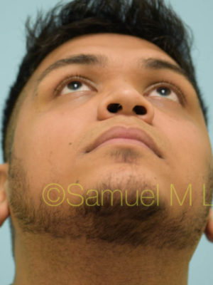 Rhinoplasty-Nose Job