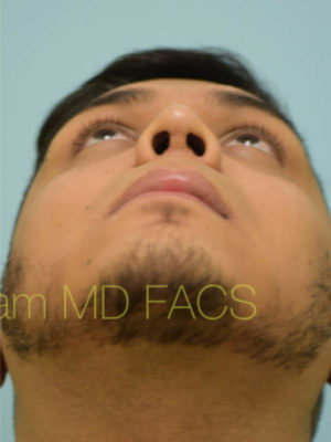 Rhinoplasty-Nose Job
