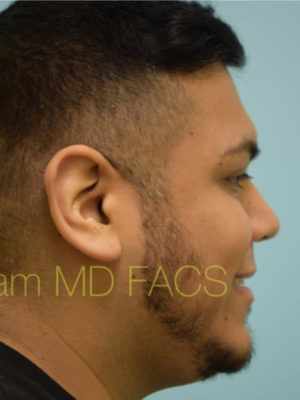 Rhinoplasty-Nose Job