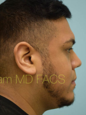 Rhinoplasty-Nose Job