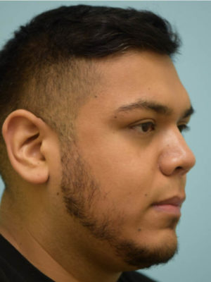 Rhinoplasty-Nose Job