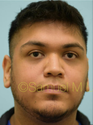 Rhinoplasty-Nose Job