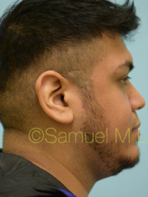 Rhinoplasty-Nose Job