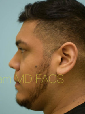 Rhinoplasty-Nose Job