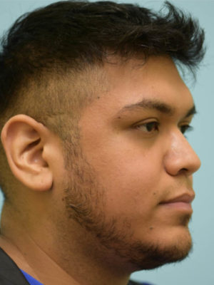 Rhinoplasty-Nose Job
