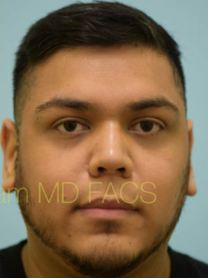 Rhinoplasty-Nose Job